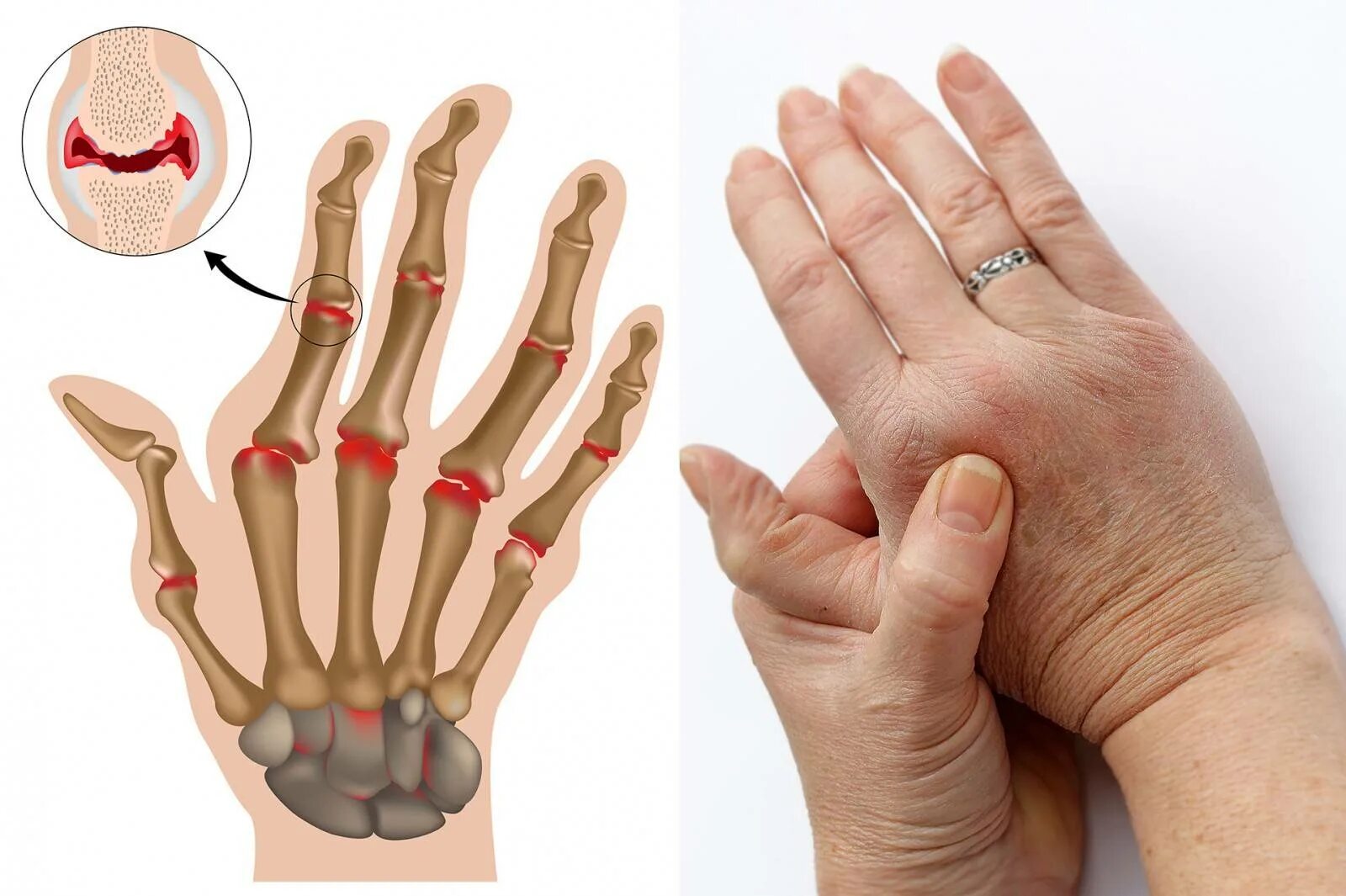 Болит сустав у основания большого пальца руки. Ревматоидный артрит кисти. Ревматоидный артрит лучезапястного сустава. Фаланга ревматоидный артрит. Анкилоз суставов пальцев.