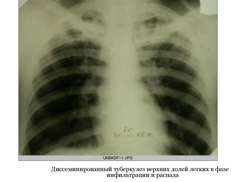 Диссеминированный туберкулез легких фазы. Милиарный туберкулез фаза инфильтрации. Подострый диссеминированный туберкулез рентген. Диссеминированный туберкулез в фазе инфильтрации. Диссеминированный туберкулез в фазе инфильтрации и распада.