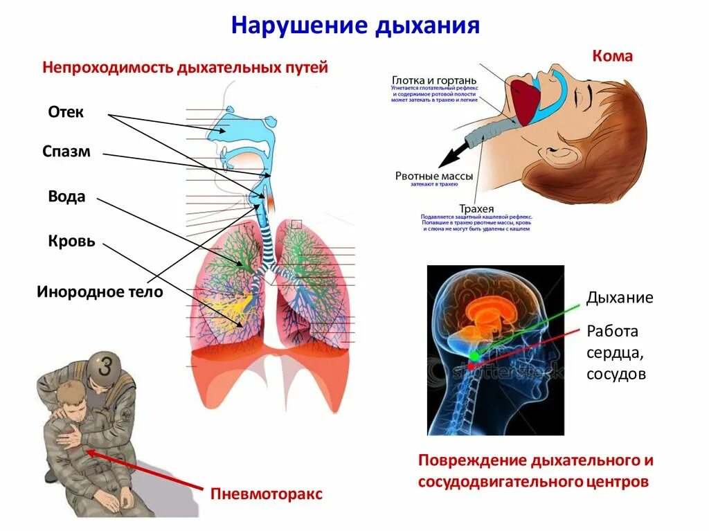 Нарушение функции дыхательной системы. Нарушение функции верхних дыхательных путей. Травмы дыхательных путей. Нарушение дыхательной функции легких.