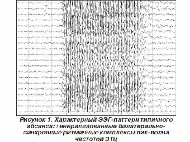 Паттерны ээг. Эпилептиформные паттерны на ээг. ээг эпилепсия пик-волна. ээг пароксизмальная активность пик волна. абсансная эпилепсия на ээг.