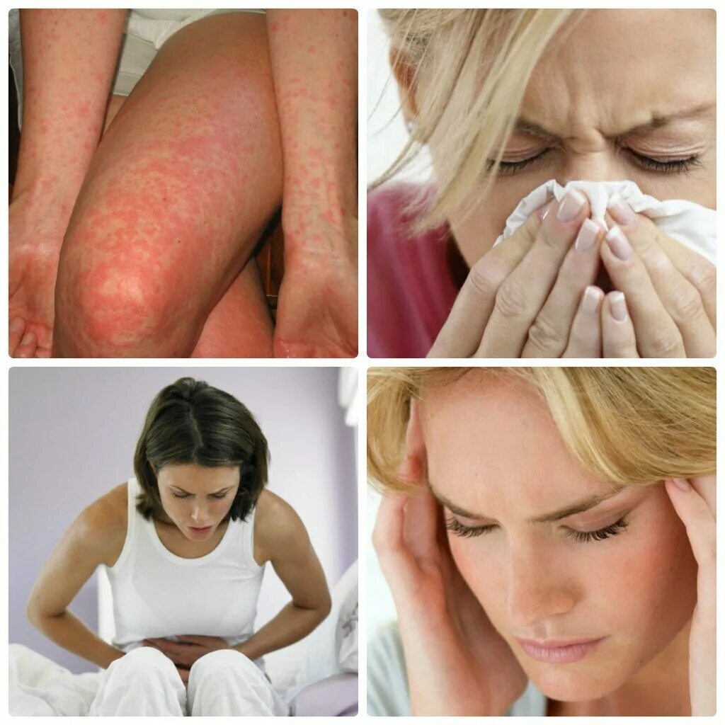 Почему может быть аллергия. Кожные аллергические реакции. Аллергическая реакция на коже.