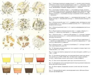 Осадок в моче что значит