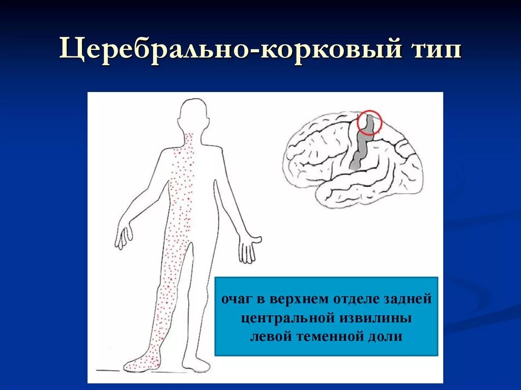 Корковый Тип расстройства чувствительности. Церебрально-корковый Тип. Церебральный Тип расстройства чувствительности. Церебральный корковый Тип нарушения чувствительности.