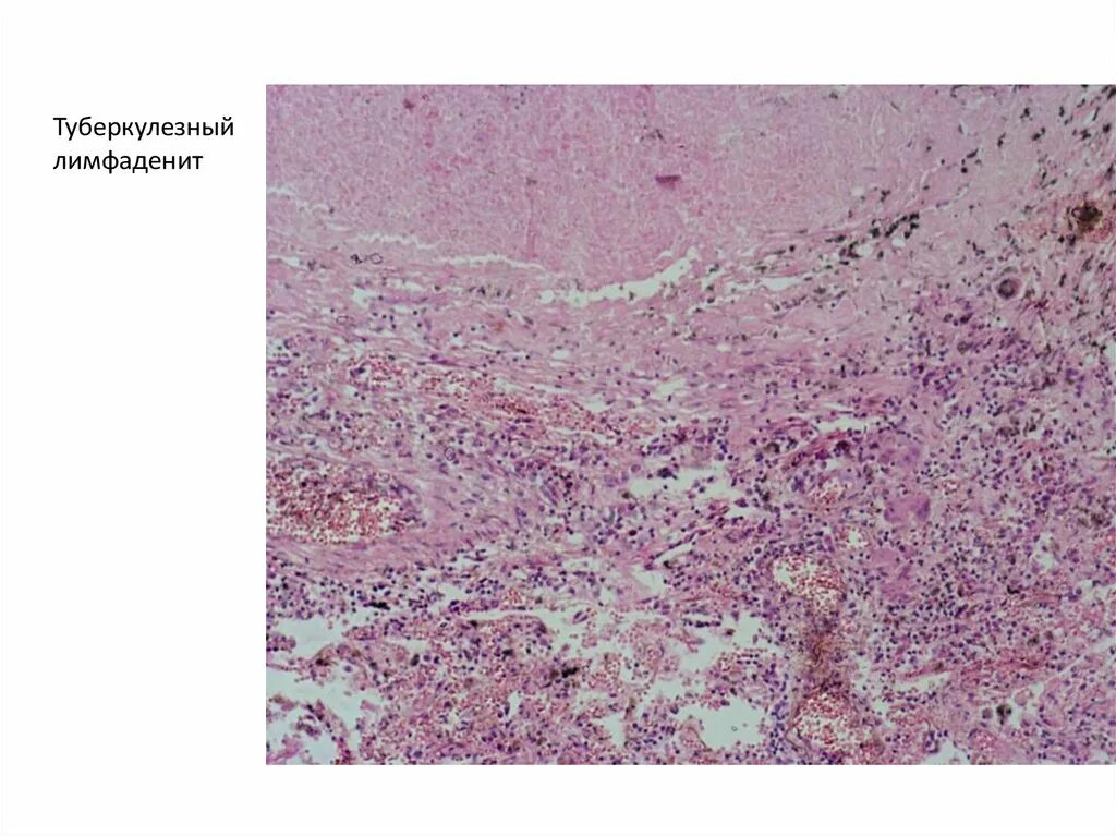 Воспаление серозной оболочки. Пиогенная гранулема гистология. Казеозный лимфаденит туберкулез. Лимфаденит патанатомия. Туберкулезный лимфаденит микропрепарат.