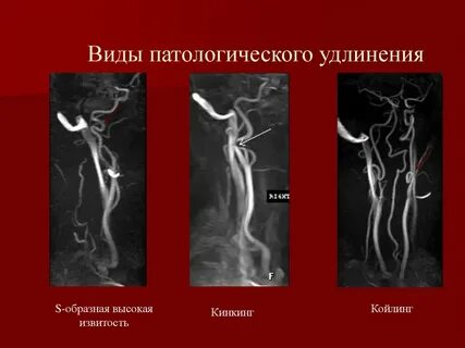 Извитость обеих позвоночных артерий