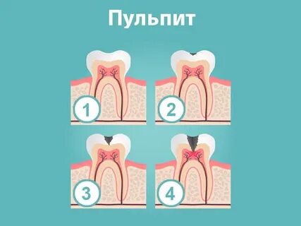Пульпит классификация