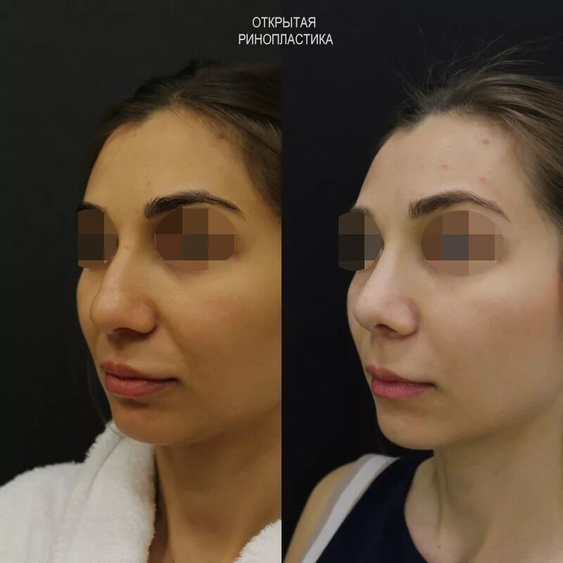 операция носа отзывы. пластика колумеллы носа. нара вардапетян ринопластика. пластика носа. иридопластика до и после.