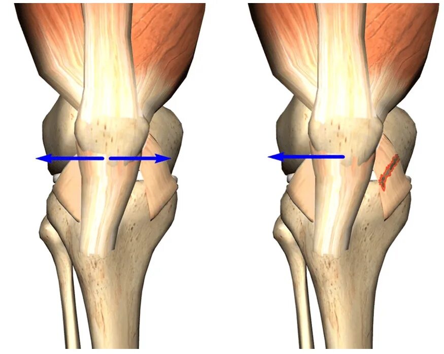 Латерализация надколенника. Дисплазия мыщелка бедренной кости коленного сустава. Латеральный вывих надколенника. Ретинакулум коленного сустава. Дисплазия латерального мыщелка коленного сустава что это.