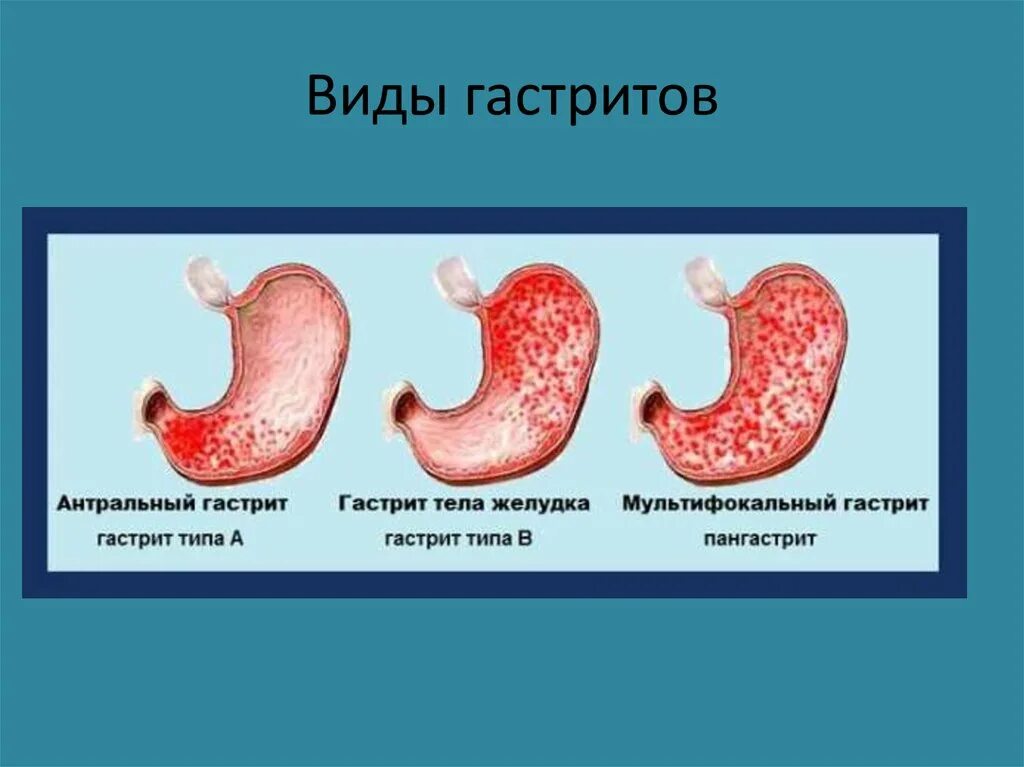 Хронический гастрит типа а. Острый и хронический гастрит. Локализация язвы желудка