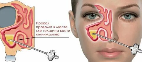 После пункции болит