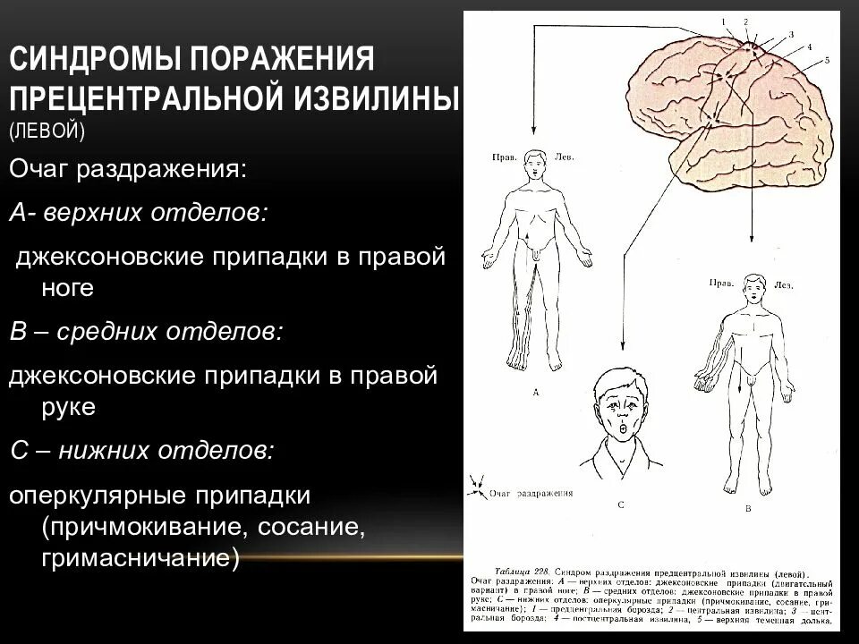 Двигательные симптомы поражения. Джексоновская эпилепсия очаг поражения. Моторная джексоновская эпилепсия. Двигательная джексоновская эпилепсия. Синдромы поражения постцентральной извилины.