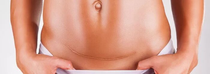 Кесарево сечение живот. Первые месячные после кесарева форум. Швы после кесарево сечкния. Рисунок кесарева сечения. Первые месячные после кесарева форум.
