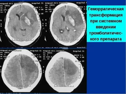 Геморрагическая трансформация ишемического инсульта