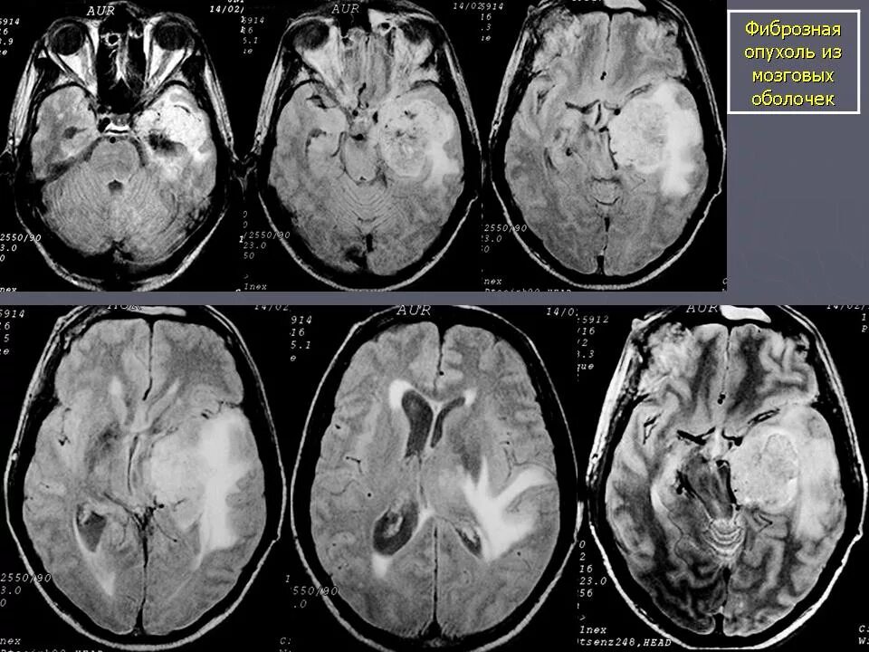 Опухоль головного глиома. Глиобластома, неоперабельная опухоль головного мозга.. Менингиомаопухоли головного мозга неврология. Опухоль головного мозга отек