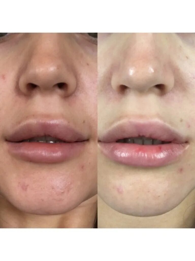 Массаж губ после увеличения. Массаж лица для увеличения губ. Формы губ до и после филлера. Формы губ до и после филлера. Контурирование губ гиалуроновой кислотой.