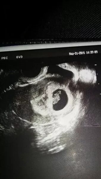 Эмбрион 13 мм. Ктр 5 5 мм. Ухо человека как зародыш. Эмбрион 13 мм. Эмбрион 13 мм.