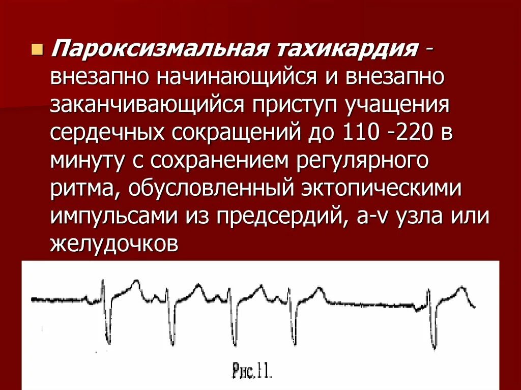 При учащении пульса длительность сердечного цикла. Пароксизмальная тахикардия ЭКГ. Пароксизм синусовой тахикардии. Пароксизмальная синусовая тахикардия. Приступ пароксизмальной тахикардии.