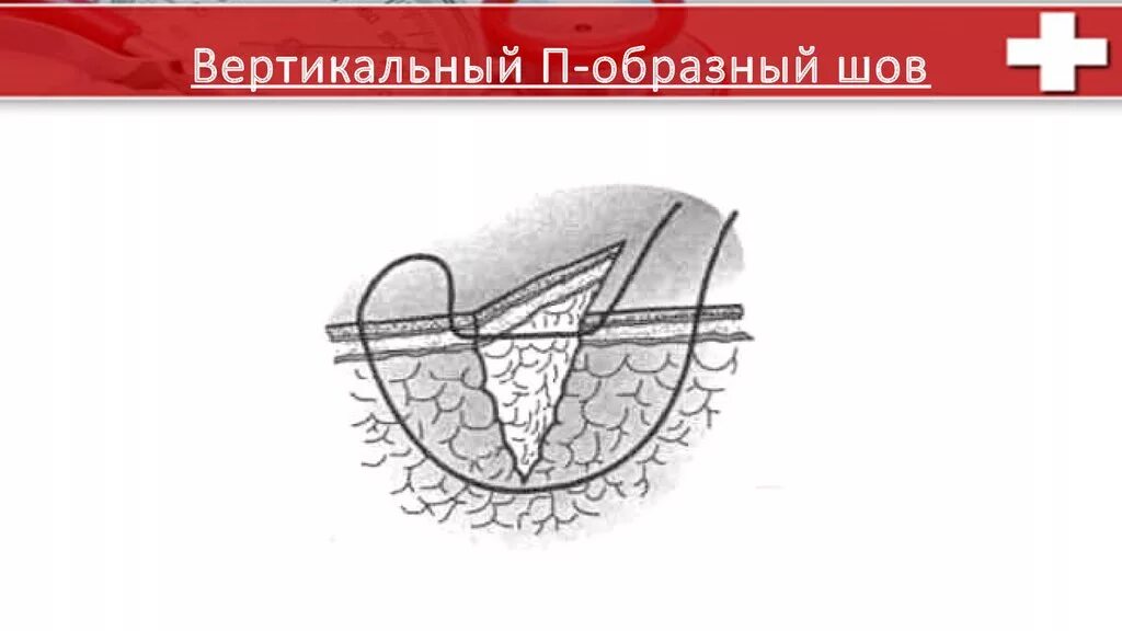 Х образный шов. Матрацный шов в хирургии. Шов Мак-Миллана –Донати. П образный шов и шов Донати. Вертикальный п образный шов.