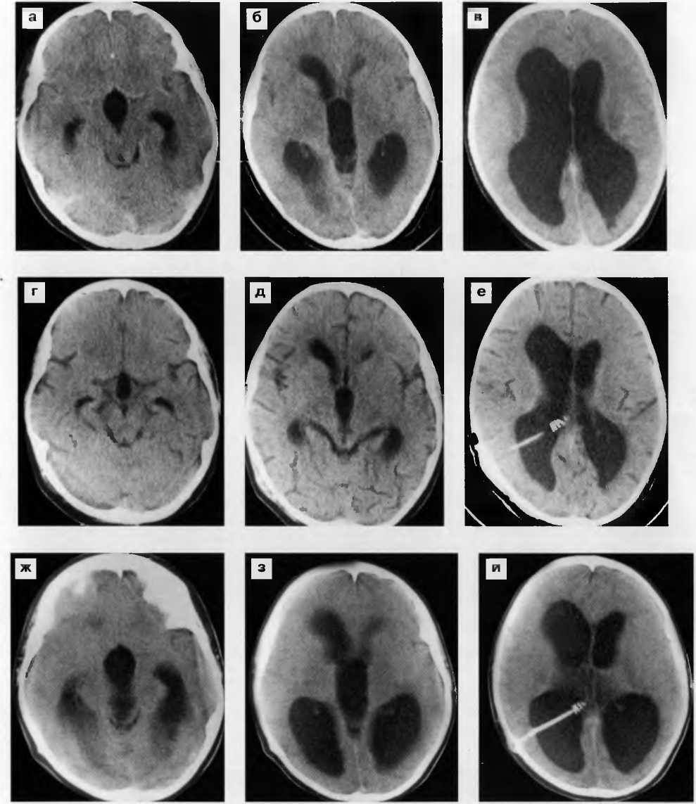 Окклюзионная шунтозависимая гидроцефалия. Окклюзионная гидроцефалия кт. Окклюзионная гидроцефалия головного мозга кт. Тетравентрикулярная гидроцефалия кт.