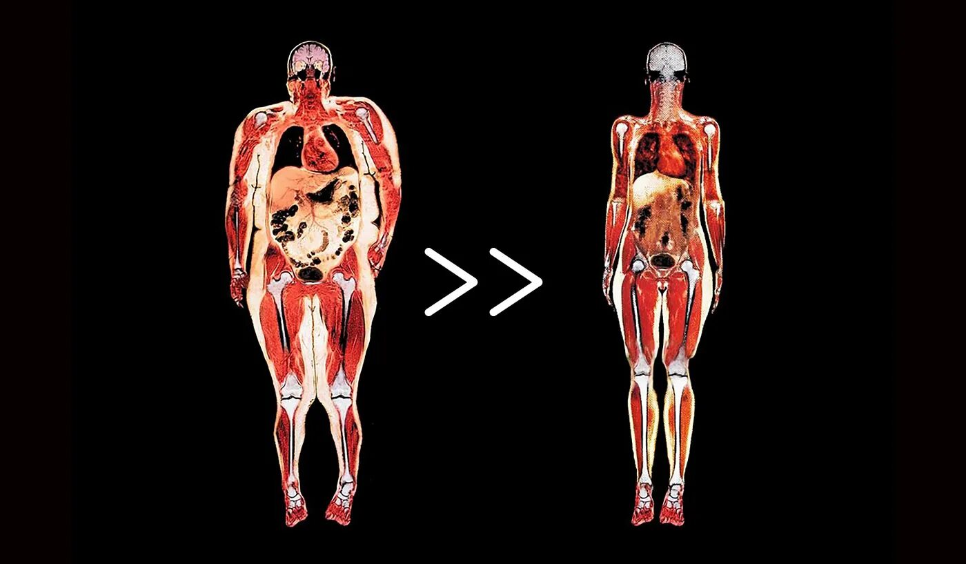 Висцеральный жир внутренних органов. Подкожный жир и висцеральный жир. Внутренние органы человека с ожирением. Избавление от висцерального жира.