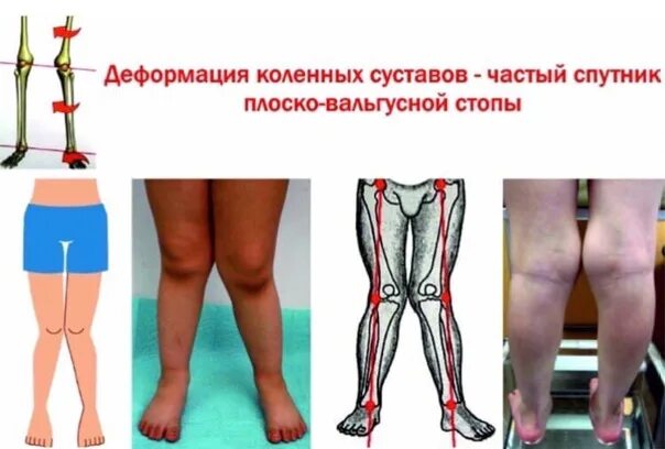 Вальгус у детей как выглядит Картинки ВАЛЬГУСНАЯ СТОПА У РЕБЕНКА 2 ГОДА