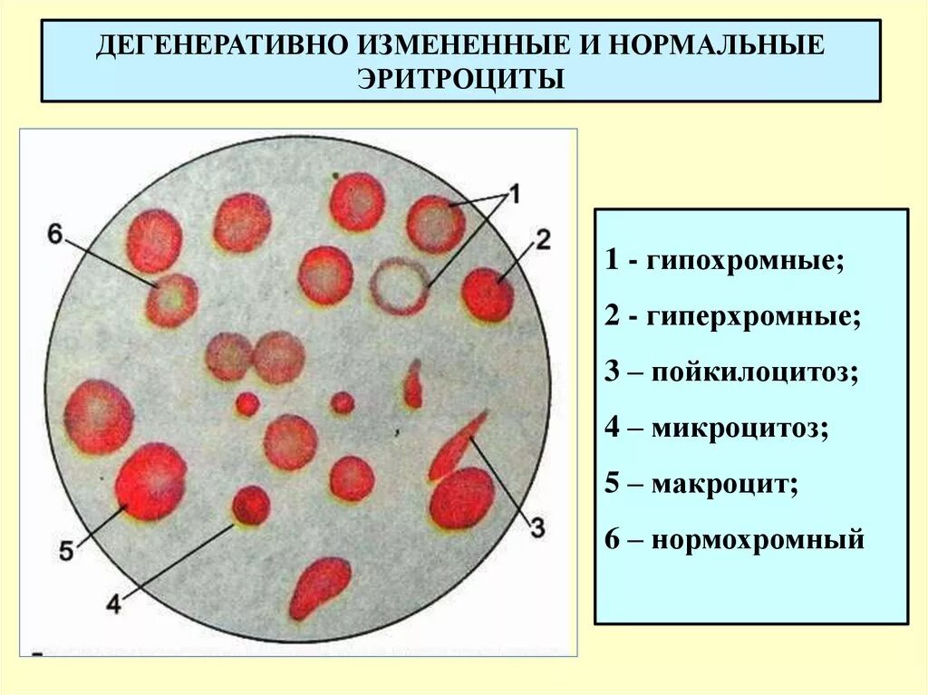 Эритроциты 5 5 у мужчин. Дегенеративно измененные эритроциты. Анизоохромные эритроциты. Гипохромные и гиперхромные эритроциты. Гипохромность эритроцитов.