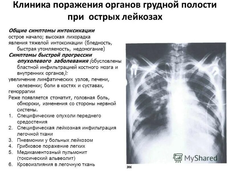 Заболевания грудной полости. Поражения органов при остром лейкозе..