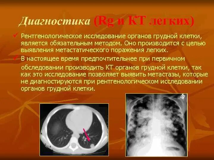 Исследование кт легких. Методы рентгенологического исследования органов грудной клетки. Поражение легких на кт. Кт лёгких показания. Легкие кт 1