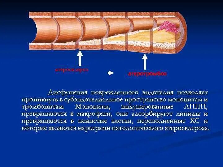 Атеросклероз лпнп. Атеросклероз лпнп