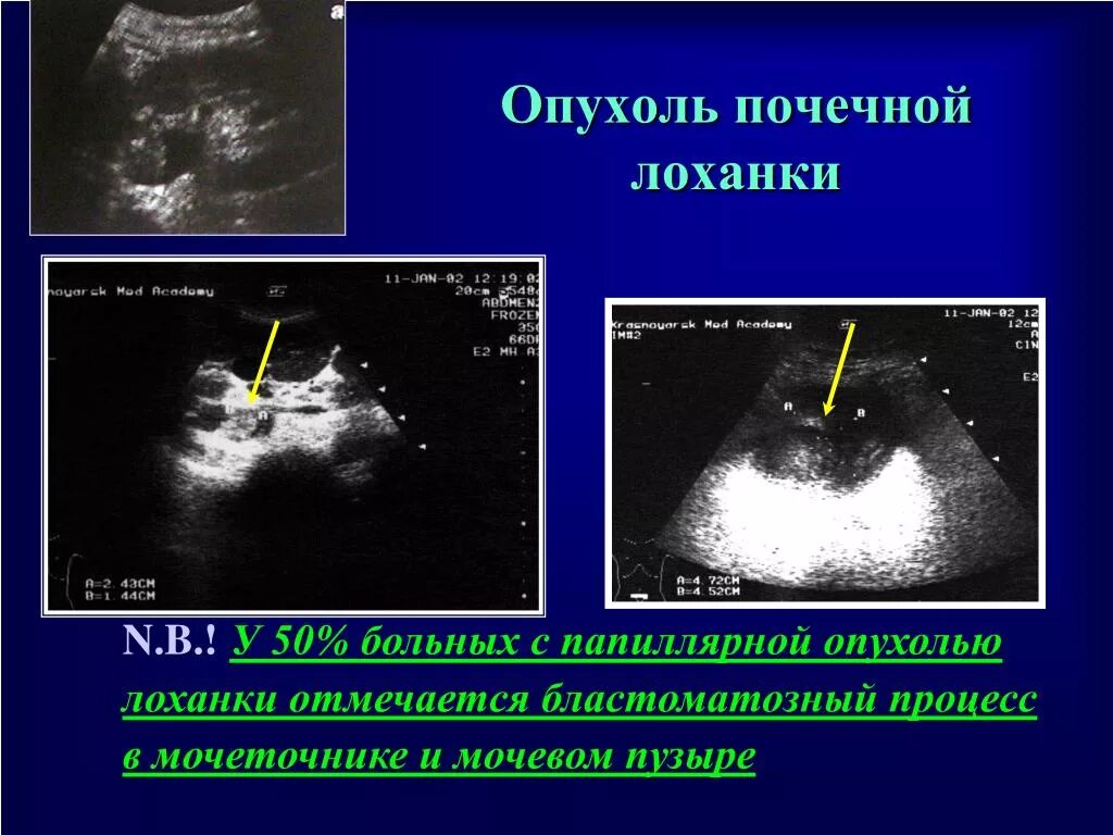 Узи лоханки почки. Ультразвуковое исследование почек опухоли. Опухоль лоханки почки кт. Опухоль лоханки почки УЗИ. Объемное образование в почке на УЗИ что это.