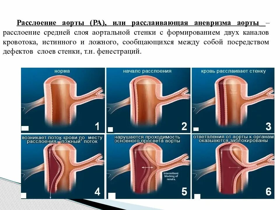 Расслаивающаяся аневризма аорты. Расслаивающая аневризма аорты патогенез. расслоение аневризмы аорты клиника. расслаивающая аневризма грудного отдела. классификация расслаивающих аневризм аорты.