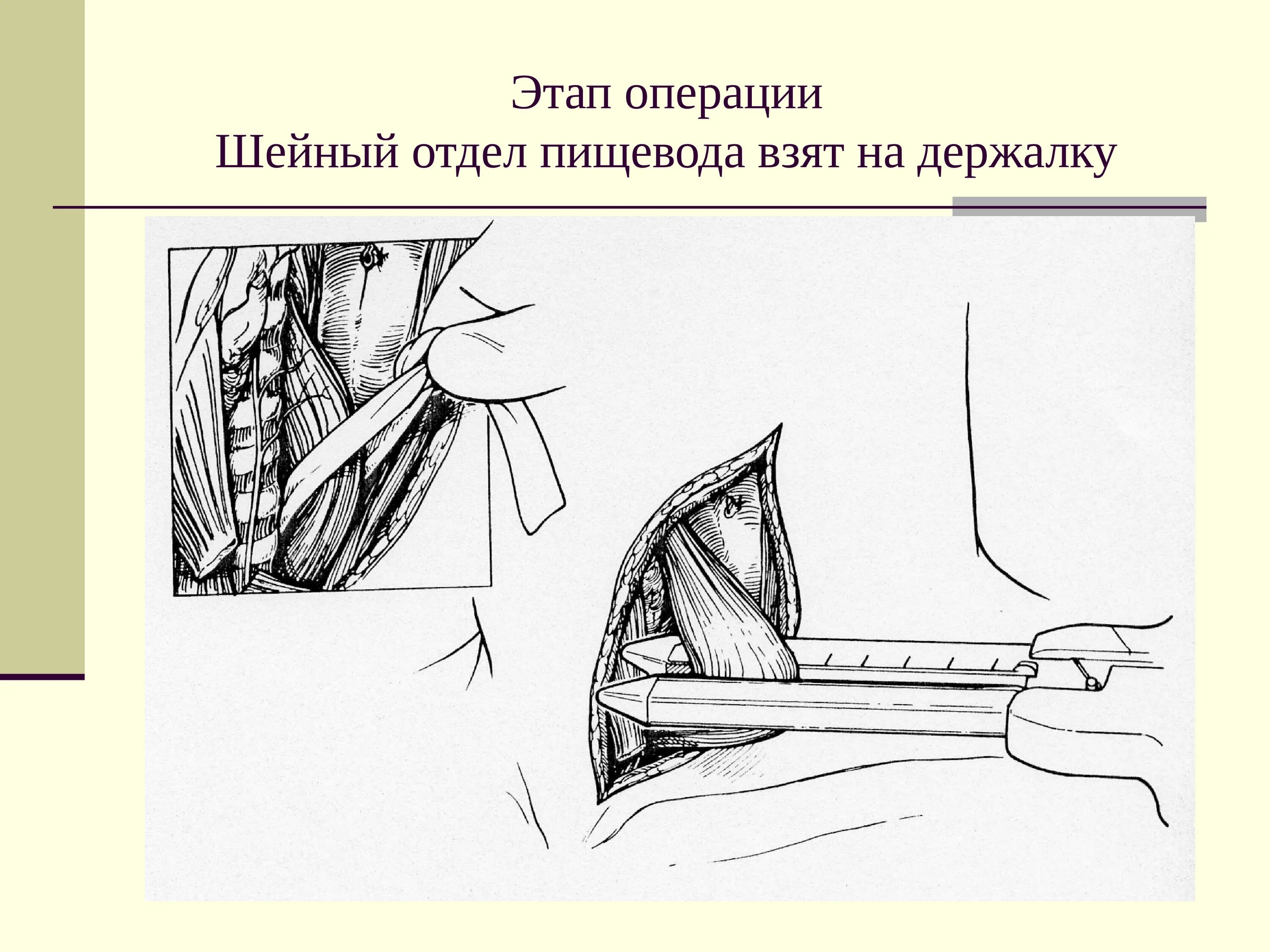 Операции на пищеводе. Операции на шейном отделе пищевода. Операции на шейной части пищевода. Операции на пищеводе доступы. Операции на шейном отделе пищевода этапы.