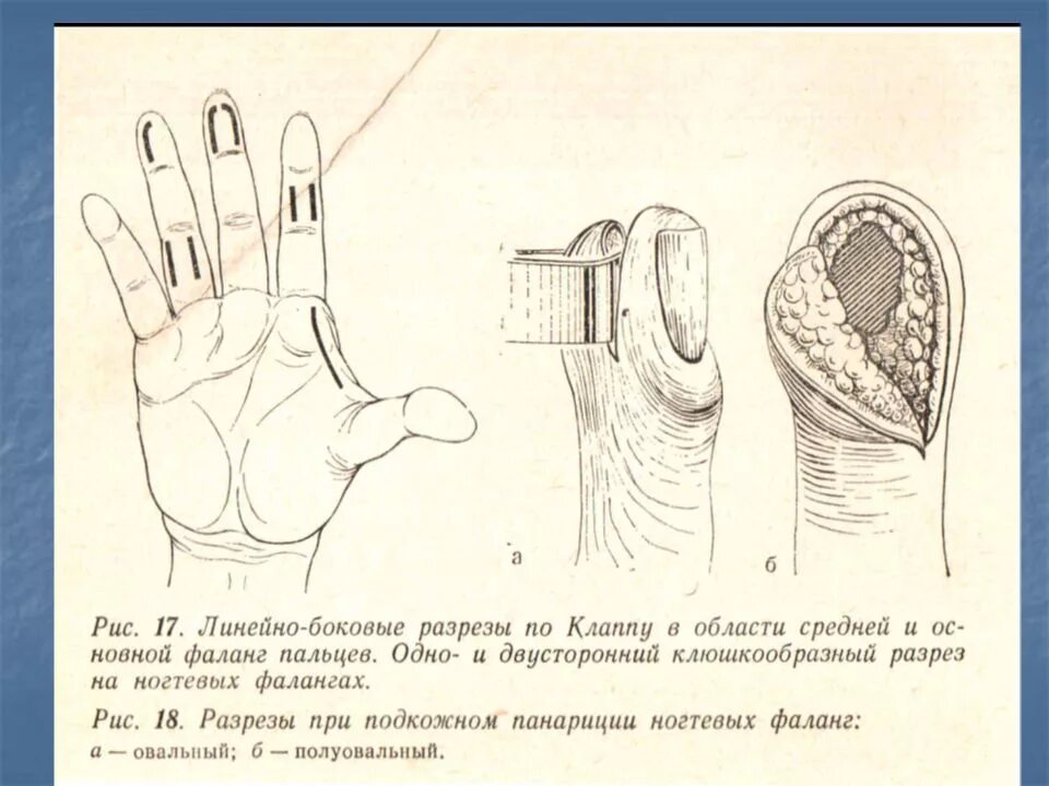 Панариций на фаланге пальца. Разрез по Клаппу при панариции. Подкожный панариций клюшкообразный разрез. Подкожный панариций разрез.