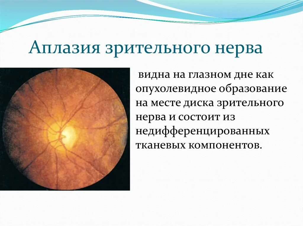 Колобома зрительного нерва. Врожденная колобома диска зрительного нерва. Аплазия диска зрительного нерва. Врожденные аномалии ДЗН.
