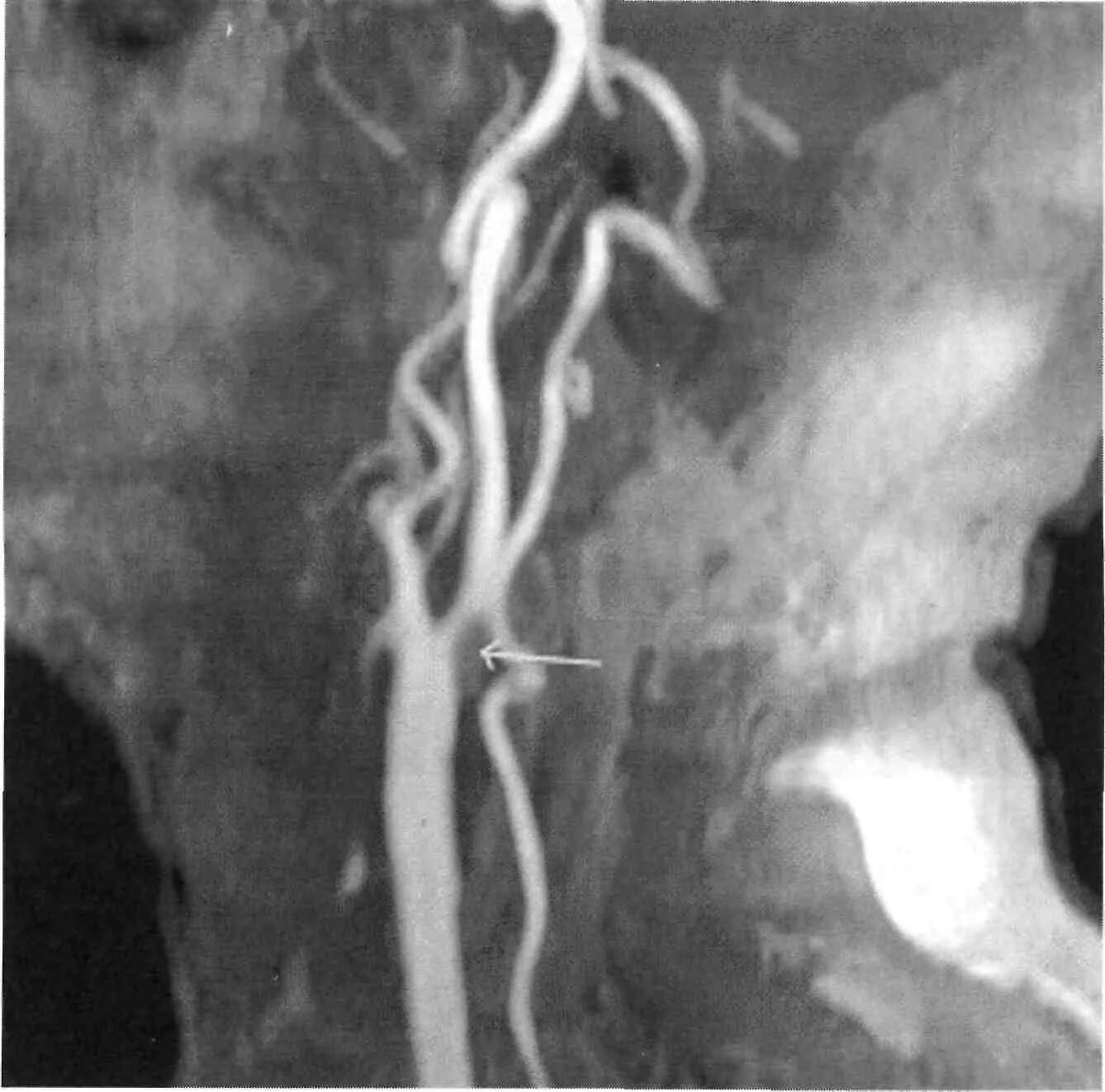 Сужение шейных сосудов. Стеноз сонной артерии на мрт. Аневризма сонной артерии шеи кт ангиография. Кт ангиография сосудов шеи аневризма.
