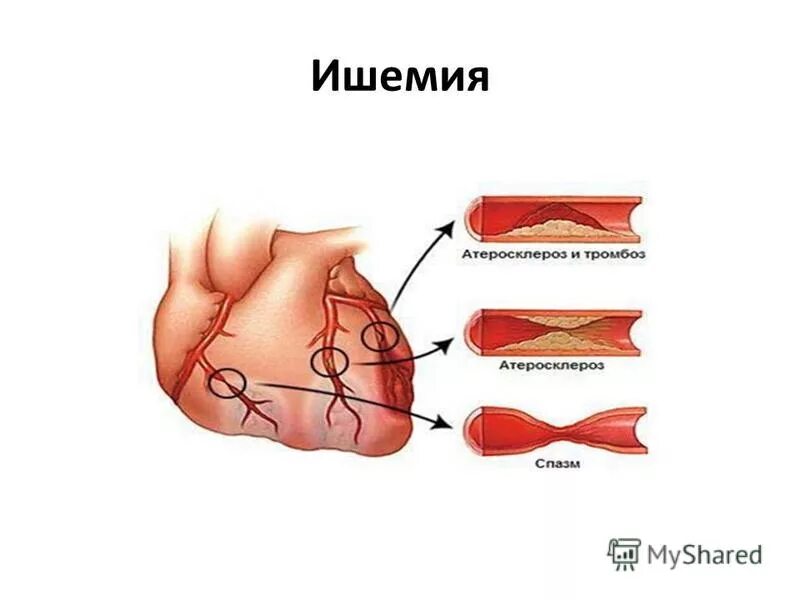 Ишемия сосудов симптомы. Виды ишемии.