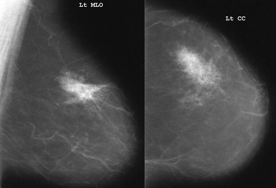 Маммография старый. Фиброзно кистозная мастопатия молочной железы bi-rads-4a. Узловая мастопатия маммограмма. Фиброаденома молочной железы birads 4 УЗИ. Маммография молочных желез ACR 3 birads 1.