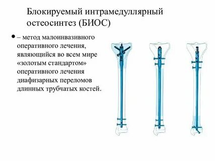 Открытый остеосинтез это