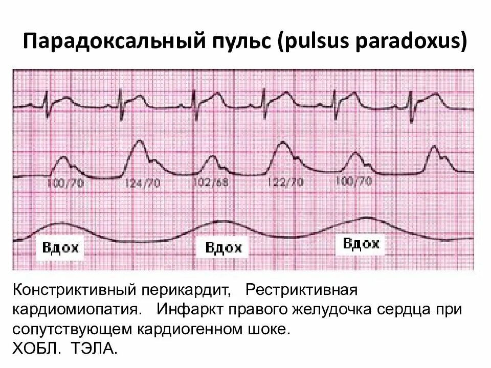 Пульс 91. График пульса здорового человека. Нормальный пульс график. Парадоксальный пульс. Нормальное биение сердца у человека.