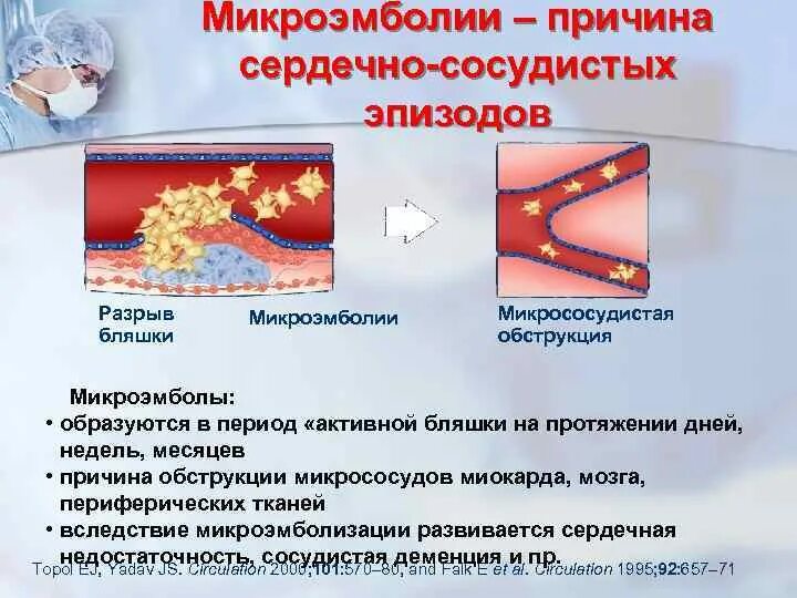 Микрососудистая обструкция.