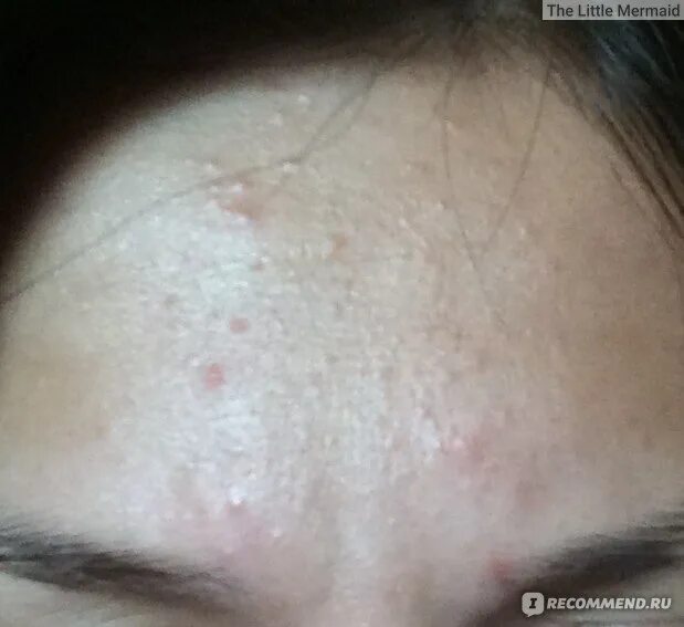 Клензит с отзывы фото до и после Отзыв о Дерматотропные средства Glenmark Клензит-С от Chelsie Chelsie Squper
