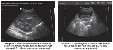 Полюса почки на узи
