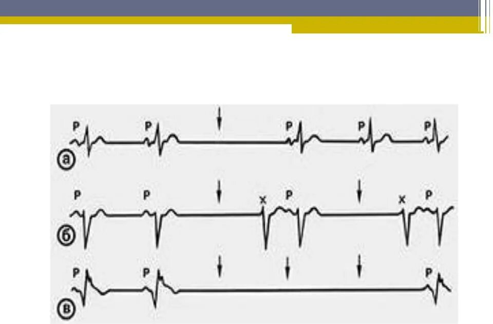Синоаурикулярная блокада. Синоатриальные блокады на ЭКГ. Интрааурикулярная блокада ЭКГ. Блокада са узла ЭКГ. Синоаурикулярная блокада 1 степени на ЭКГ.