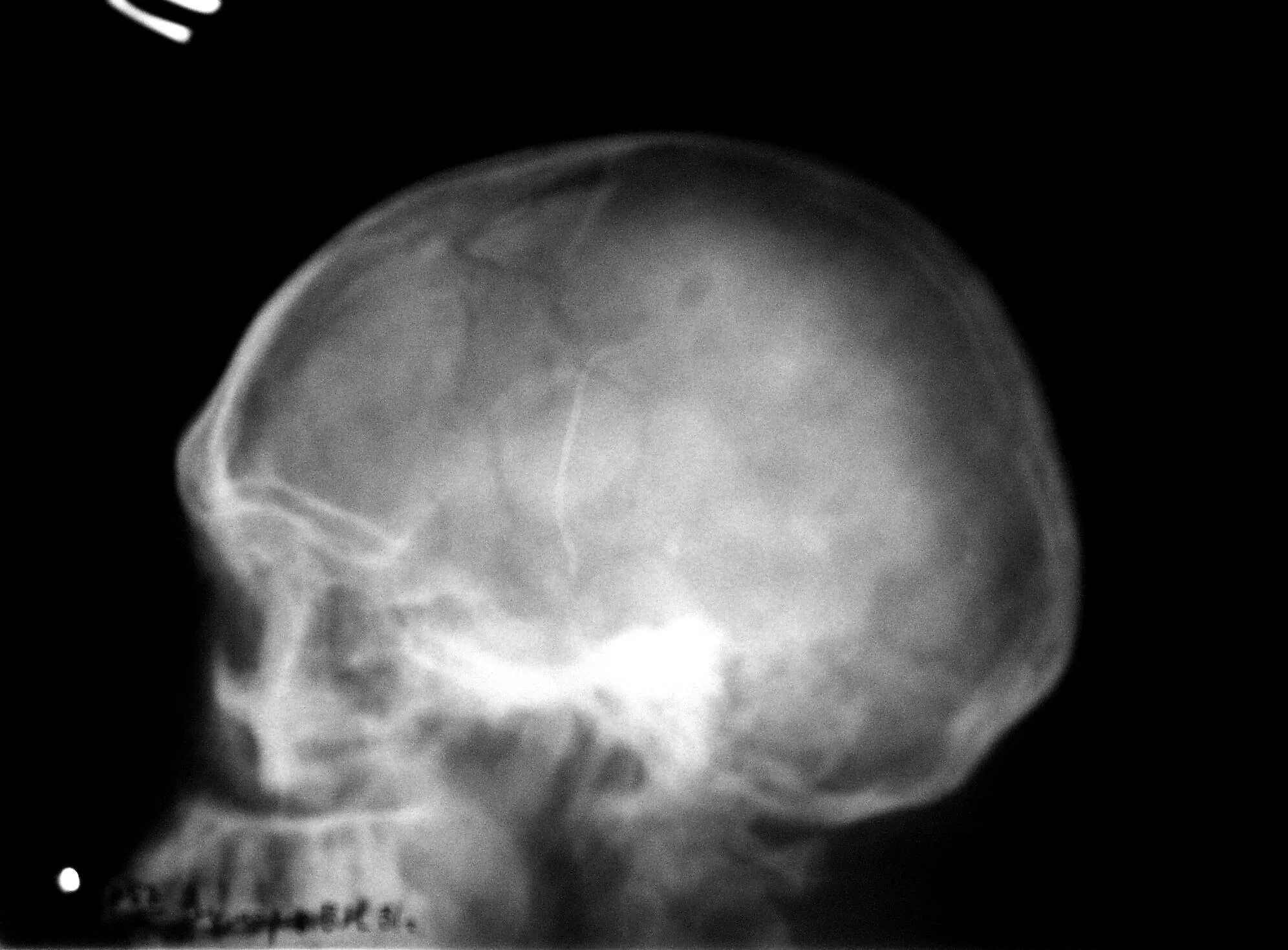 Кости черепа рентген. Перелом теменной кости черепа рентген. Перелом костей черепа рентген. Перелом теменной кости рентген.