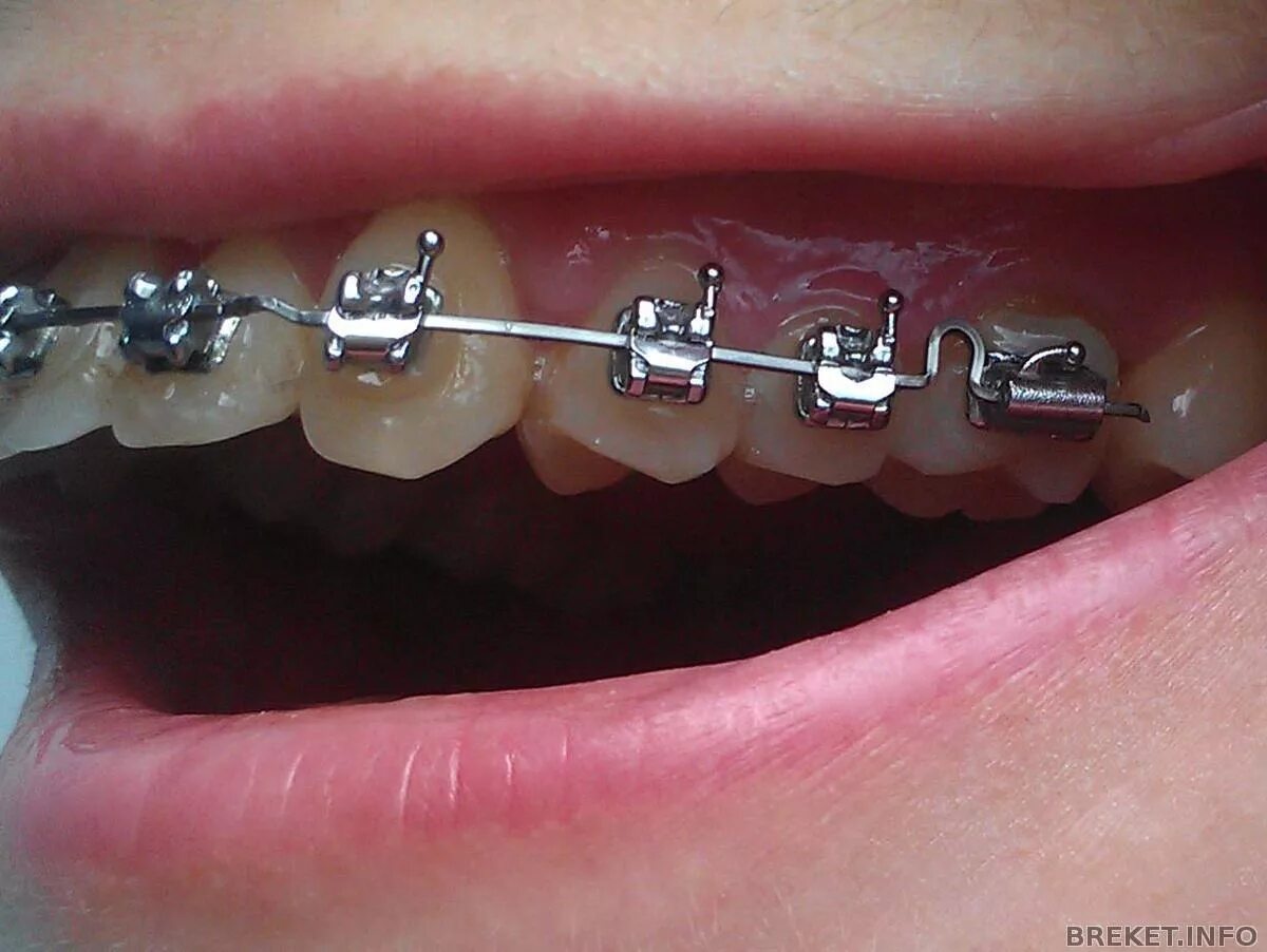 Вылетела дуга из последнего брекета. Дуга отстегнулась на брекетах. Выскочила дуга из брекета. Квадратная дуга для брекетов. Прямоугольная дуга для брекетов.