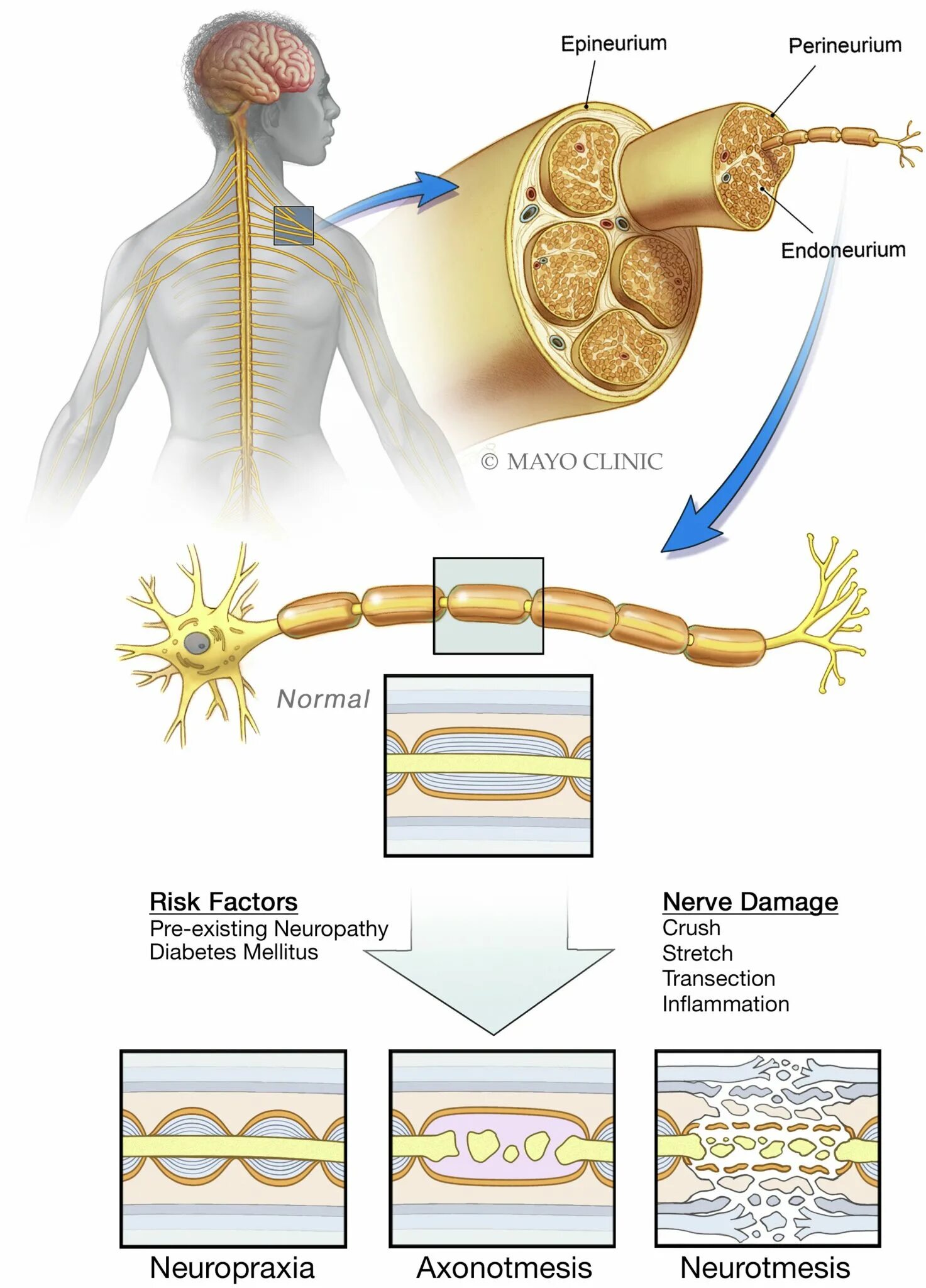 Getting on nerve перевод. Классификации mayo clinic. сэддон нейротмезис. peripheral nerves are composed of bundles of axon.