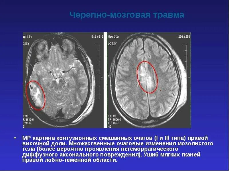 Диффузной биполушарной кортикальной атрофии