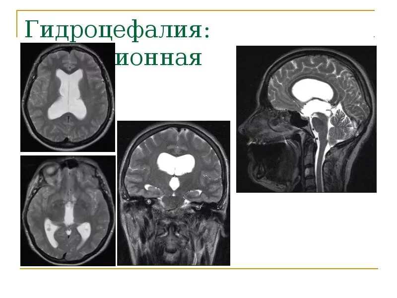 Умеренная гидроцефалия головного мозга у взрослых. Внутренняя окклюзионная гидроцефалия мрт. внутренняя обструктивная гидроцефалия. гидроцефалия наружная головного мозга. окклюзионная тривентрикулярная гидроцефалия.
