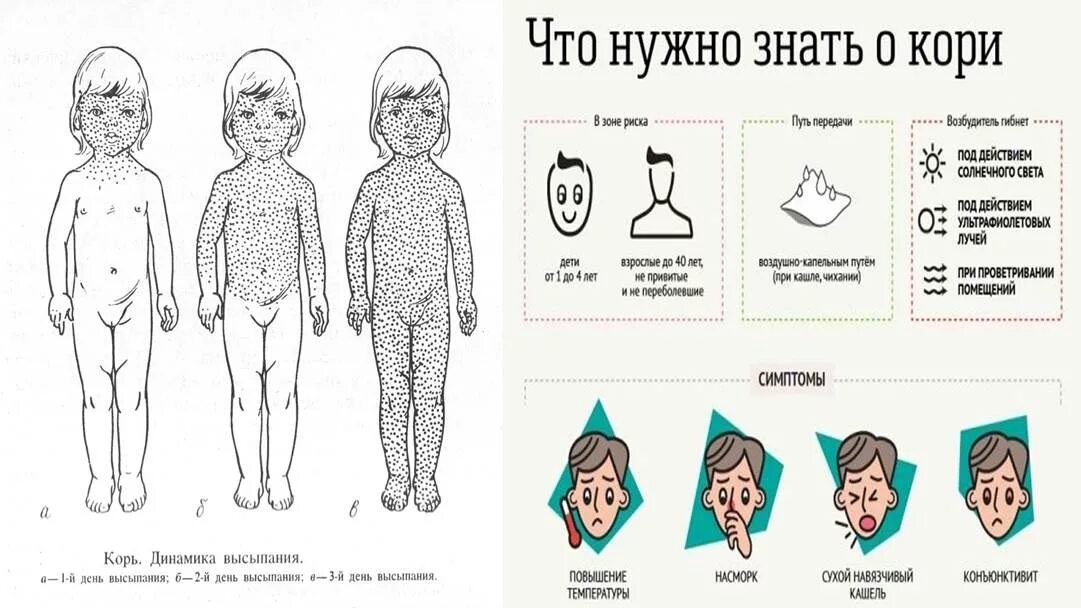 Корь симптомы и лечение. Корь у детей у детей клинические рекомендации. Пути передачи корь и краснуха. Корь симптомы у детей сыпь. Сыпь корь краснуха сыпь симптомы.