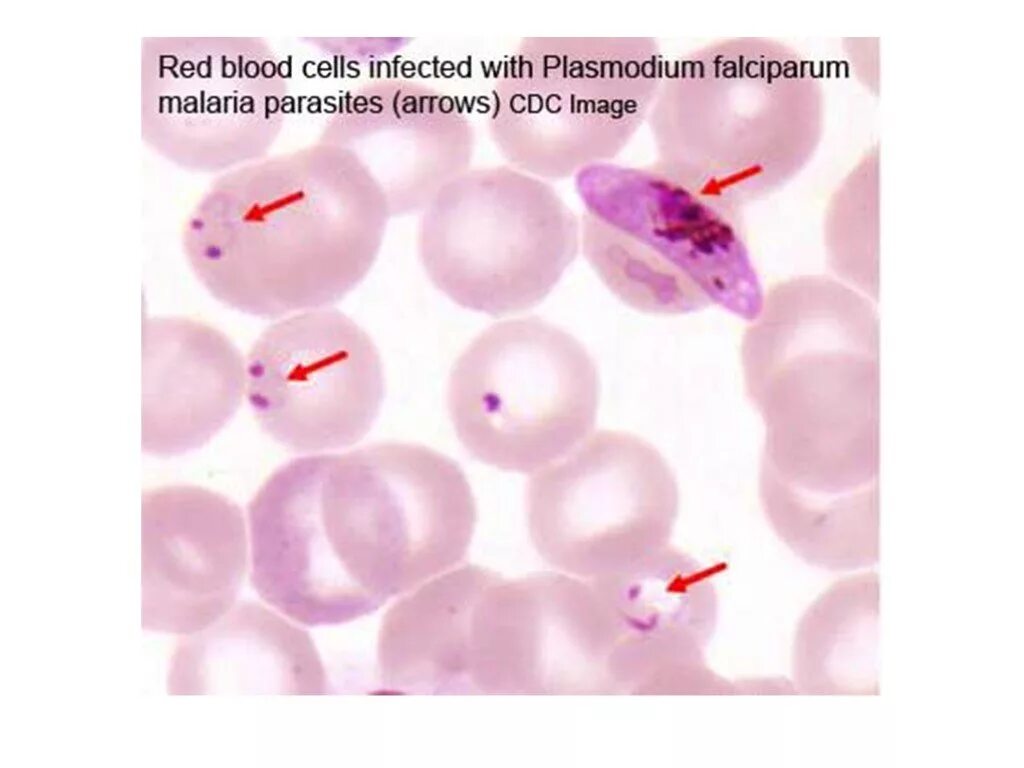 Малярия тестирование. Лабораторная диагностика малярийного плазмодия. Методы диагностики малярийного плазмодия. Малярийный плазмодий толстая капля. Малярийный плазмодий исследуемый материал.